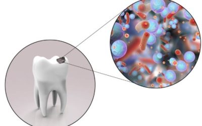 Constantly Getting Cavities? We May Know Why