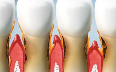 5 Different Ways to Keep Your Gums Extra Healthy