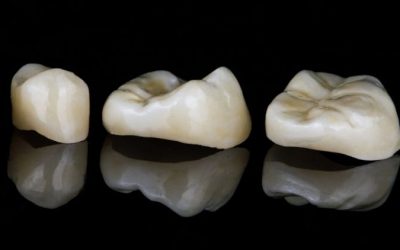 What is an Inlay? What is an Onlay? What’s the Difference Between Them?
