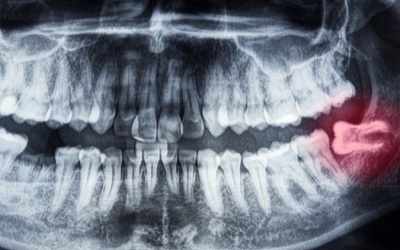 5 Home Remedies For Wisdom Tooth Pain