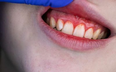 Addressing Bleeding Gums: Understanding Causes and Preventive Measures