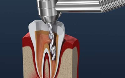 Managing Dental Discomfort: From Root Canals to Prevention