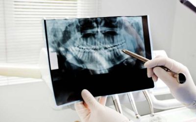 Benefits of Dental X-Rays: Why They’re Essential for Your Oral Health