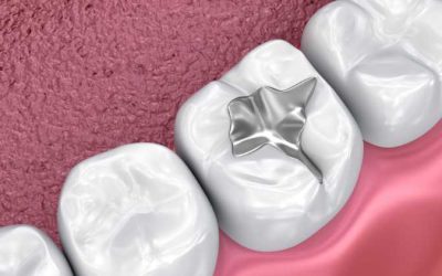 Understanding the Different Types of Tooth Fillings: A Comprehensive Guide