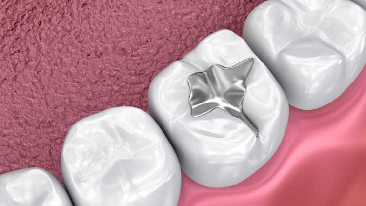 Understanding the Different Types of Tooth Fillings: A Guide