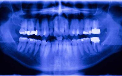 Why Do I Need Dental X-Rays? The Importance and Safety of Dental X-Rays