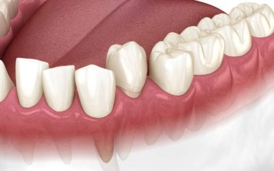 How Long Does A Bite Adjustment Take?