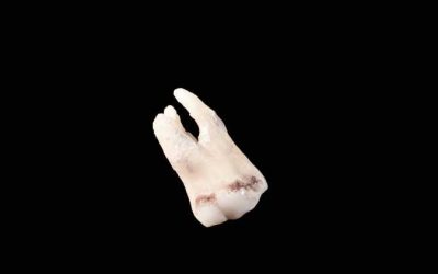 Why Is There A Black Spot On My Tooth?