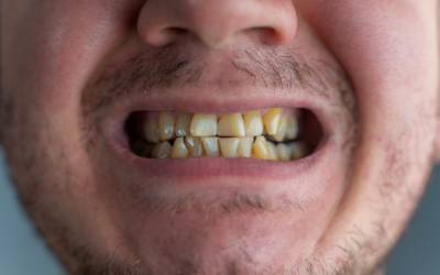 What Foods Stain Teeth?
