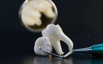 What Happens If I Don’t Get My Wisdom Teeth Out?