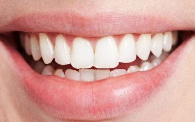 What Are Peg Laterals?