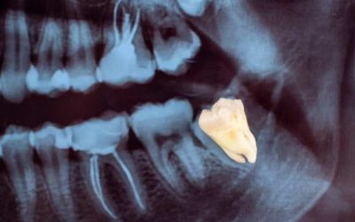 Why Do I Only Have Two Wisdom Teeth?
