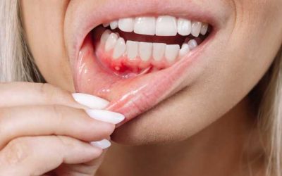 My Gums Won’t Stop Bleeding: Causes and Solutions