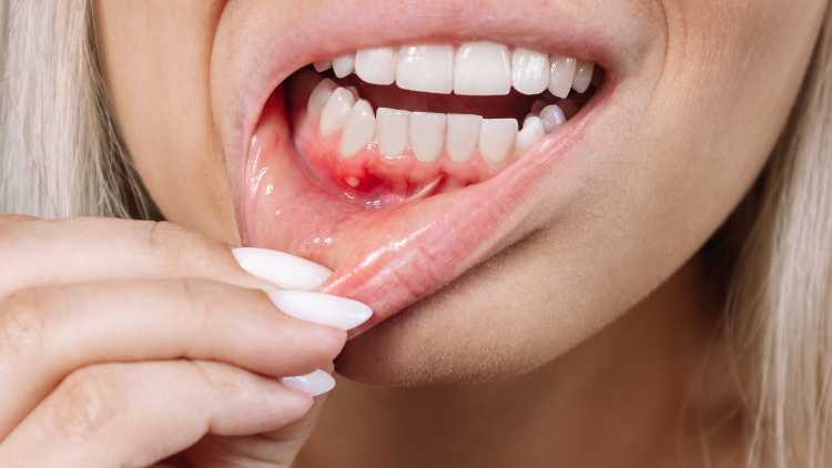 My Gums Won’t Stop Bleeding: Causes and Solutions