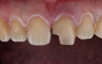 How to Fix a Chipped Tooth: Treatment Options and Steps to Take