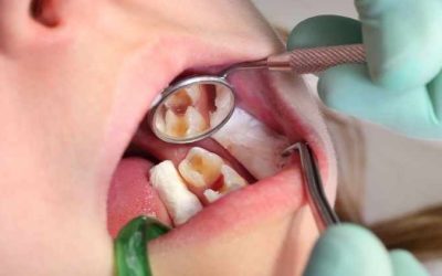 Could You Spot a Cavity? Here’s What to Look For