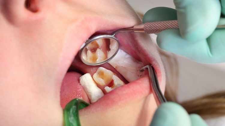 Could You Spot a Cavity? Here’s What to Look For