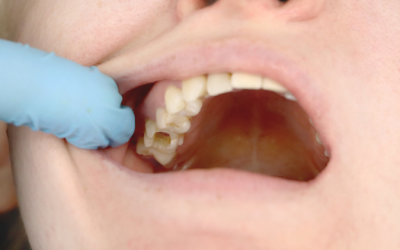 What Does a Cavity Look Like? Recognizing Early Signs of Tooth Decay